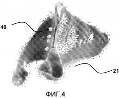 Устройство эндопротезирования плечевого сустава (патент 2569531)