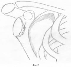 Способ оперативного лечения привычного вывиха плеча (патент 2405482)
