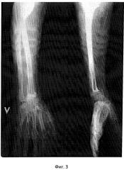 Способ оперативного анатомо-функционального восстановления лучезапястного сустава при повреждении лучевой кости (патент 2537780)