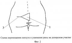 Способ лечения эпителиального копчикового хода (патент 2422104)