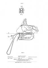 Устройство для визуальной прицельной пункции основной пазухи (патент 547213)