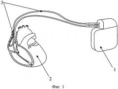 Способ замены эндокардиальных электродов имплантируемых антиаритмических устройств после ортотопической трансплантации сердца по биатриальной методике (патент 2562104)