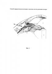 Способ хирургического лечения глаукомы путем резекции склеры (патент 2587856)