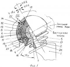 Биартикулярный эндопротез тазобедренного сустава со сферической гидростатической опорой головки (патент 2653805)