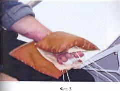 Способ лечения и профилактики гипертрофических и келоидных рубцов с использованием хитозана (патент 2424812)