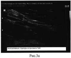 Способ ультразвуковой диагностики начальных этапов формирования тромбозов глубоких вен голени в раннем послеоперационном периоде (патент 2547072)