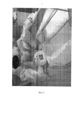 Способ стабилизации реберного клапана при флотирующем переломе ребер (патент 2578182)