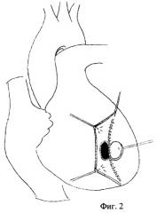 Способ закрытия постинфарктного межжелудочкового дефекта с одновременным устранением аневризмы сердца (патент 2266714)