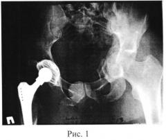 Способ хирургического лечения переломов вертлужной впадины (патент 2547803)