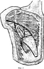 Способ хирургического доступа к подмышечному лимфатическому коллектору (патент 2335255)