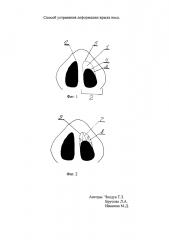 Способ устранения деформации крыла носа (патент 2621383)