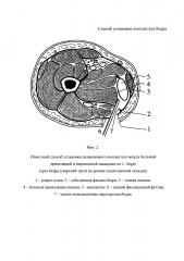 Способ установки имплантата бедра (патент 2626271)