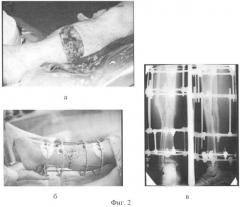 Способ лечения открытого перелома костей голени (патент 2354315)