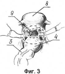 Способ хирургического лечения хронического колопроктогенного запора (патент 2414861)