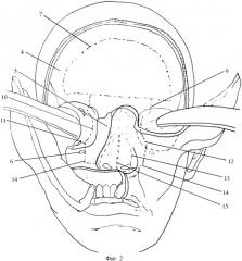 Способ доступа при операциях по поводу опухолей полости носа и центральной части основания черепа (патент 2408293)
