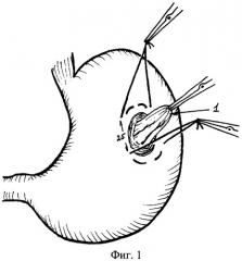 Способ наложения постоянной гастростомы из слизистой желудка (патент 2308895)