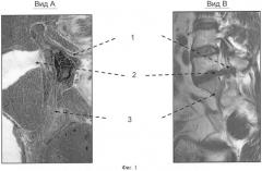 Способ выявления остеохондроза пояснично-крестцового отдела позвоночника (патент 2382603)