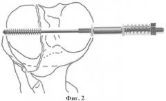 Устройство для остеосинтеза (патент 2345731)