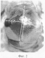 Способ определения локализации проводной точки головки по изменениям черепа у умерших плодов и новорожденных (патент 2470583)
