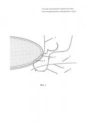 Способ ненатяжной герниопластики послеоперационных вентральных грыж (патент 2647148)