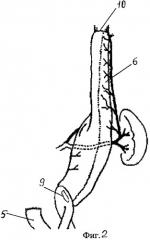 Способ эзофагогастропластики при рубцовых сужениях пищевода и антрального отдела желудка (патент 2356502)