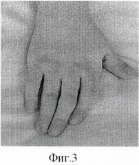 Способ устранения сгибательных контрактур и ульнарной девиации 2-5 пальцев кисти (патент 2411014)