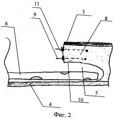 Способ закрытия послеоперационной раны после иссечения эпителиального копчикового хода (патент 2430690)