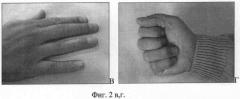 Способ лечения повреждений сухожилия разгибателя пальца кисти (патент 2334479)