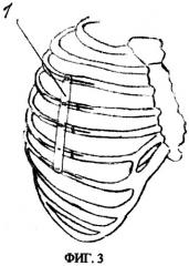 Способ и устройство для лечения множественных переломов ребер и грудины (патент 2503424)