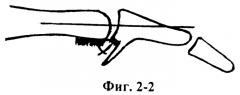 Способ лечения разгибательной контрактуры пальца в проксимальном межфаланговом суставе (патент 2464947)