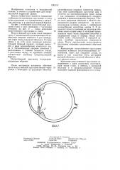 Искусственный хрусталик глаза (патент 1242157)