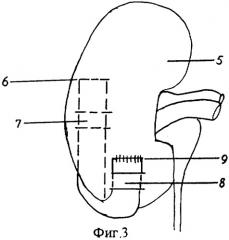 Способ нефропексии (патент 2302828)