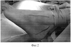 Способ забора остеохондрального аутотрансплантата (патент 2562706)