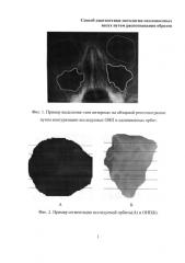 Способ диагностики патологии околоносовых пазух путем распознавания образов (патент 2585700)
