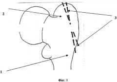 Способ профилактики перелома большого вертела при эндопротезировании тазобедренного сустава (патент 2290116)
