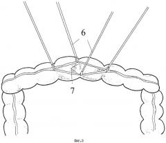 Способ удаления тканей из брюшной полости через кишку при лапароскопическом доступе (патент 2288668)