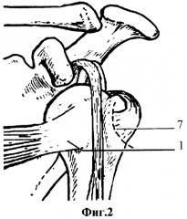 Способ оперативного лечения застарелого вывиха головки плечевой кости (патент 2321361)