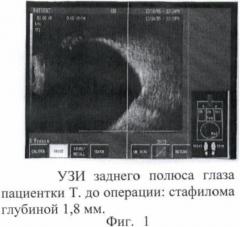 Способ склерореконструктивного лечения высокой близорукости (патент 2367394)