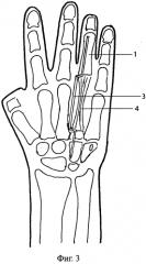 Способ восстановления пальца кисти (патент 2550301)