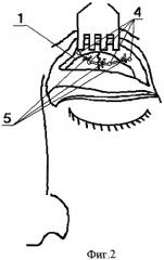 Способ лечения переломов передней и нижней стенок лобных пазух (патент 2271166)
