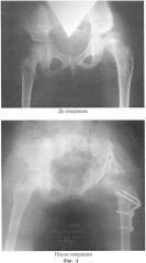 Способ транспозиции вертлужной впадины после тройной остеотомии таза (патент 2414185)