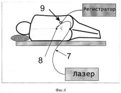 Метод лазерного интервенционного воздействия при остеохондрозе (патент 2321373)