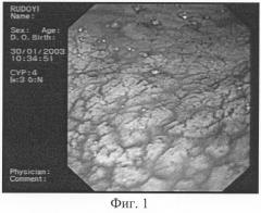 Способ диагностики хронического гастрита (патент 2282397)