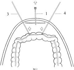 Способ удаления тканей из брюшной полости через кишку при лапароскопическом доступе (патент 2288668)