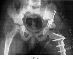 Способ выполнения коррегирующей остеотомии подвздошной кости (патент 2541787)
