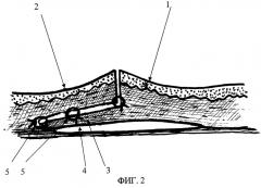 Способ формирования и соединения краев кожной раны при удалении гипертрофических рубцов (патент 2270618)