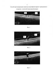 Способ прогнозирования перехода витреофовеолярного тракционного синдрома в сквозной макулярный разрыв (патент 2576813)