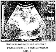 Способ предоперационной подготовки больного с острой постнекротической кистой поджелудочной железы к наложению панкреатоцистодигестивного анастомоза (патент 2294701)