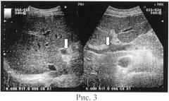 Способ ультразвукового определения объема печени (патент 2515396)