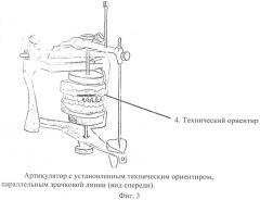 Способ конструирования протетической плоскости (патент 2573555)